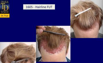 Hair restoration procedure before and after results