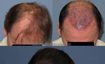 Hair transplantation surgery before and after photos