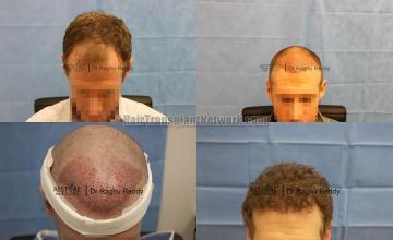 Hair restoration procedure before and after results