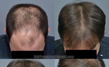 Hair restoration procedure before and after pictures