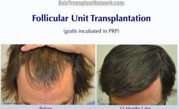 Hair transplantation surgery before and after photos