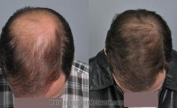 Top view before and after hair restoration results