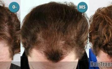 Top view before and after hair restoration results