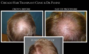 Hair transplantation surgery before and after pictures