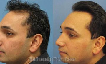 Left view before and after hair restoration procedure