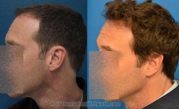 Hair restoration procedure before and after pictures