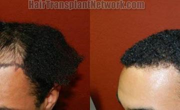 Hair transplantation surgery before and after images