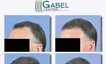 Hair transplantation surgery before and after pictures