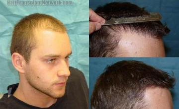 Right side hair transplant before and after photos