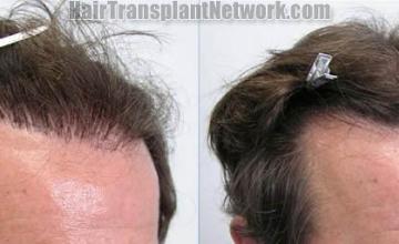 Preoperative and postoperative hair transplant photos