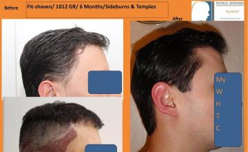 Hair restoration surgery before and after images