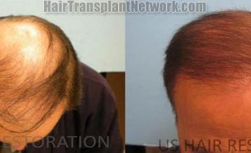 Hair restoration procedure before and after results