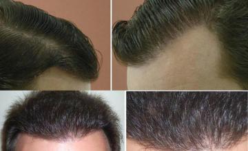 Hair transplantation surgery before and after pictures