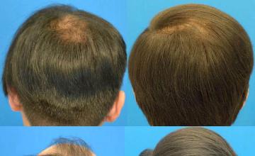 Hair transplantation surgery before and after photos