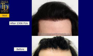 Hair restoration procedure before and after results
