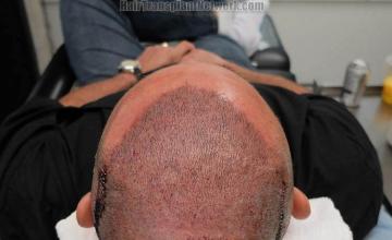 Hair transplantation surgery before and after pictures