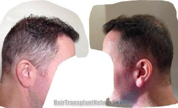 Hair transplantation surgery before and after pictures