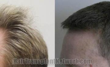 Hair transplantation surgery before and after pictures