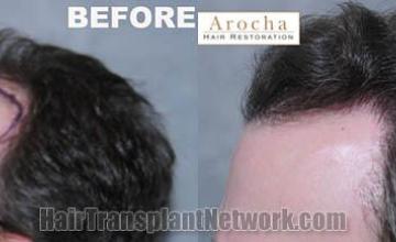 Hair transplantation surgery before and after pictures