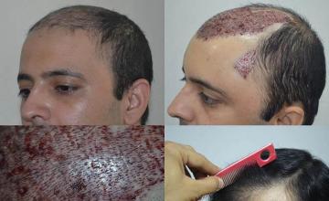 Hair transplantation surgery before and after pictures