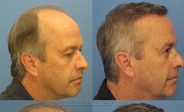 Before and after right view hair transplant photos