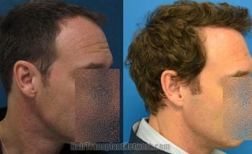 Hair transplantation surgery before and after pictures