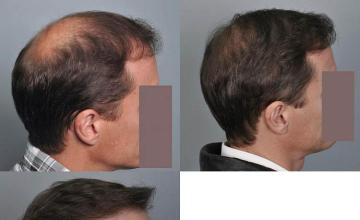 Hair restoration procedure before and after results