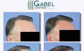 Hair transplantation surgery before and after images