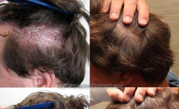 Donor Scar before and after hair transplant photos