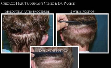 Hair restoration procedure before and after pictures