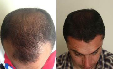 Hair transplantation surgery before and after photos