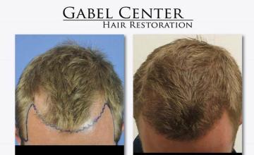 Hair transplantation surgery before and after photos