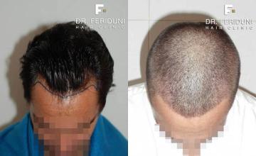 Top view before and after hair restoration results