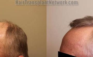 Hair transplantation surgery before and after pictures