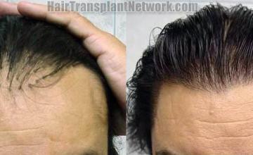 Hair restoration procedure results