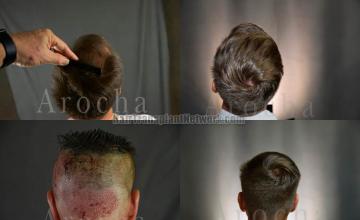 Hair replacement surgery before and after images