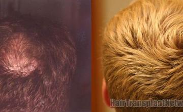 Top / crown view before and after hair transplant