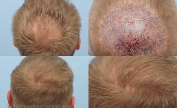 Hair transplantation surgery before and after photos