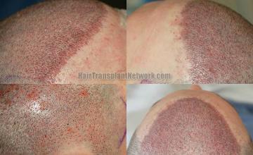 Hair replacement surgery before and after images