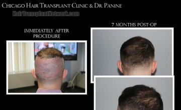 Hair replacement surgery before and after images