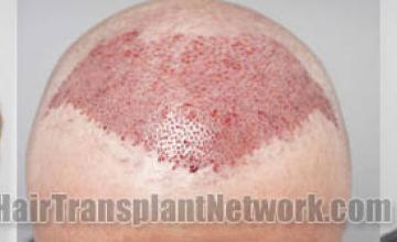 Before and after hair restoration procedure images