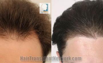 Before and after hair transplant procedure images