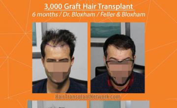 Front view - Before and after hair restoration procedure