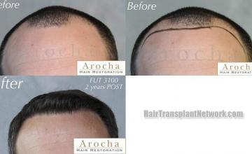 Hair restoration procedure before and after results