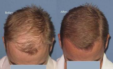 Top view before and after hair restoration results