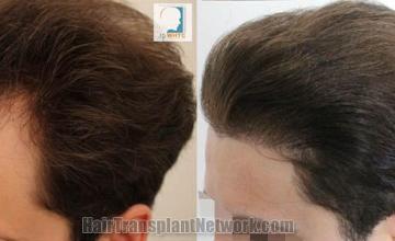 Hair transplantation surgery before and after images