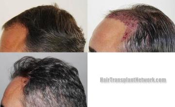 Hair restoration procedure before and after pictures
