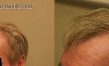 Left view before and after hair restoration procedure