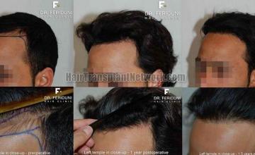 Before and after hair restoration procedure - Left views