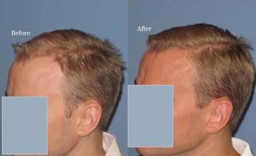 Hair transplantation surgery before and after photos